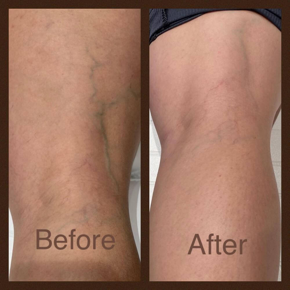 Before and After Image of Treating Unwanted Veins On Legs